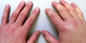 یک توصیه پزشکی مهم / چرا ورم ناگهانی پا را باید جدی گرفت؟