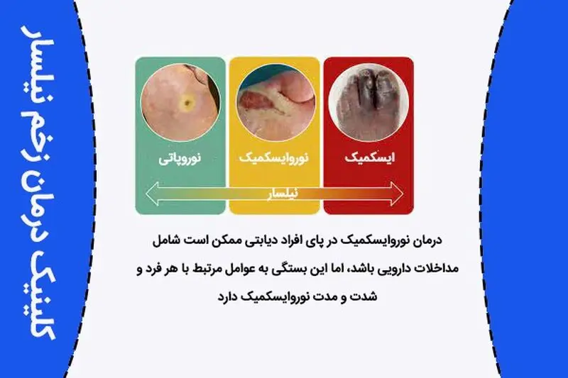 نوروایسکمیک 