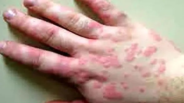 مهمترین علائم «پوستی» ابتلا به کرونا چیست؟ 