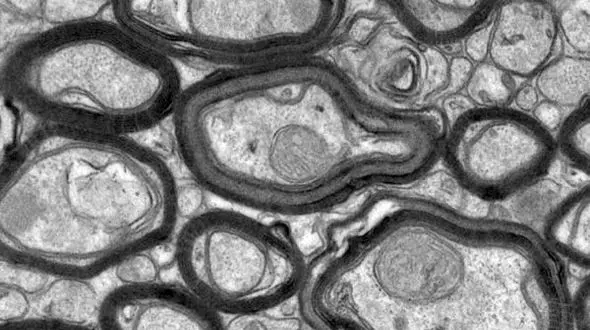 بیماری ام اس با پپتید مصنوعی قابل درمان است