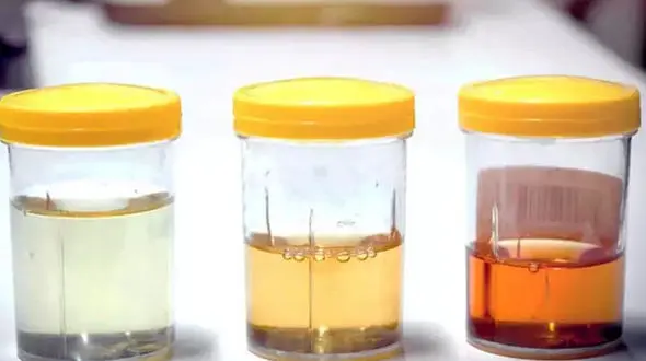 ادرار سفید در زنان نشانه چیست؟