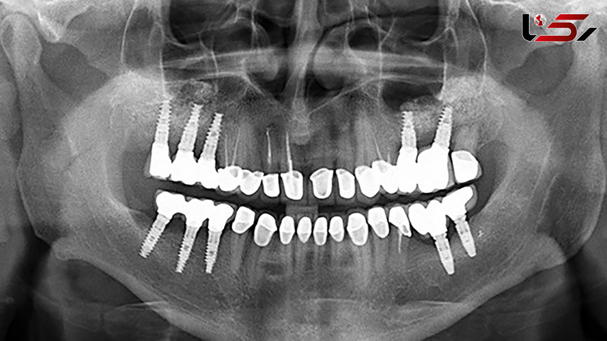 هشدار یک پزشک؛ تصویربرداری غلط دندانپزشکی می‌تواند فاجعه‌آفرین باشد!