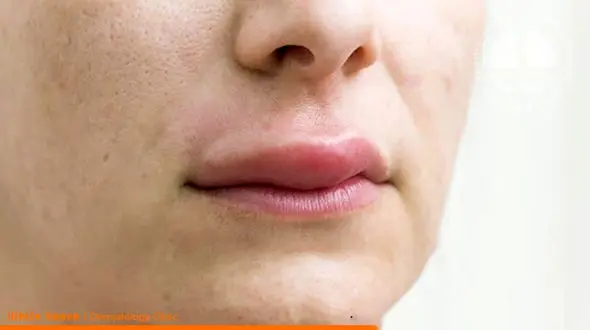 تزریق ژل در بدن چه عوارضی دارد؟