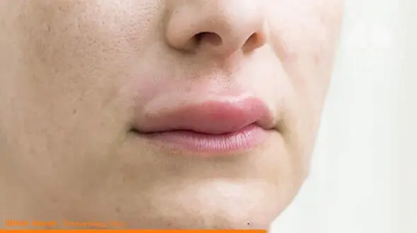 تزریق ژل در بدن چه عوارضی دارد؟