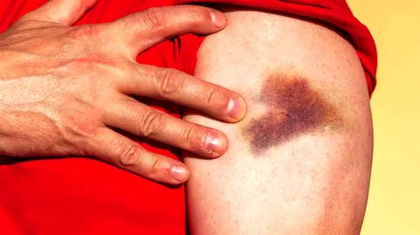 کبودی بدن به دلیل کمبود چه ویتامینی است؟ 