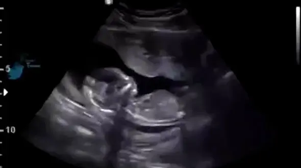 فیلم پربازدید  سکسکه جنین 12 هفته ای قبل از تولد .../ مبهوت میشید