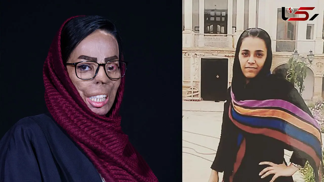 عروس حسود روی نوعروس اسید پاشید + فیلم گفتگو و عکس قبل و بعد 