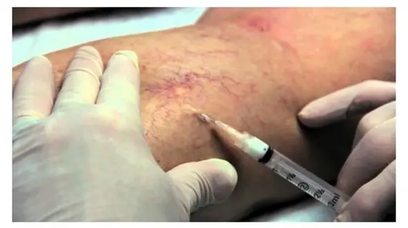 هشدار واریس / خانم ها لطفا این خبر را جدی بگیرید