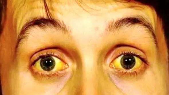 آیا هپاتیت B مسری است؟ توضیحات یک پزشک متخصص