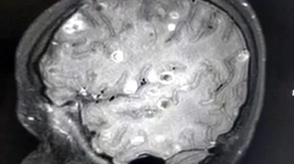 کرم ها در داخل مغز این دختر بچه 8 ساله چه می کردند؟