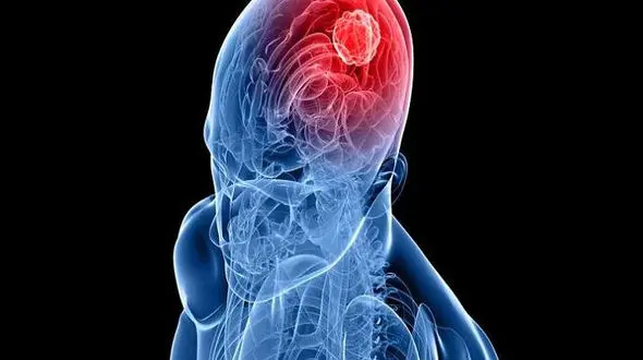 درمان سرطان مغز با ویروس زیکا