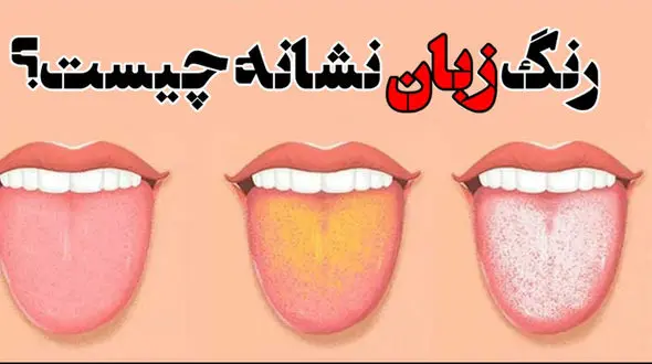 نشانه های بیماری از روی رنگ زبان 