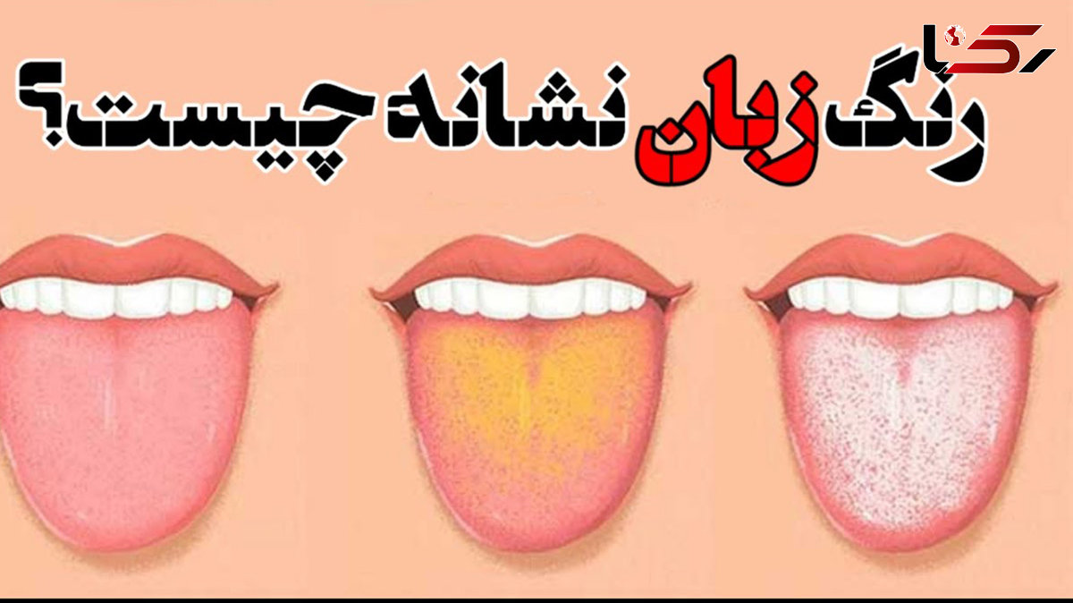 نشانه های بیماری از روی رنگ زبان 