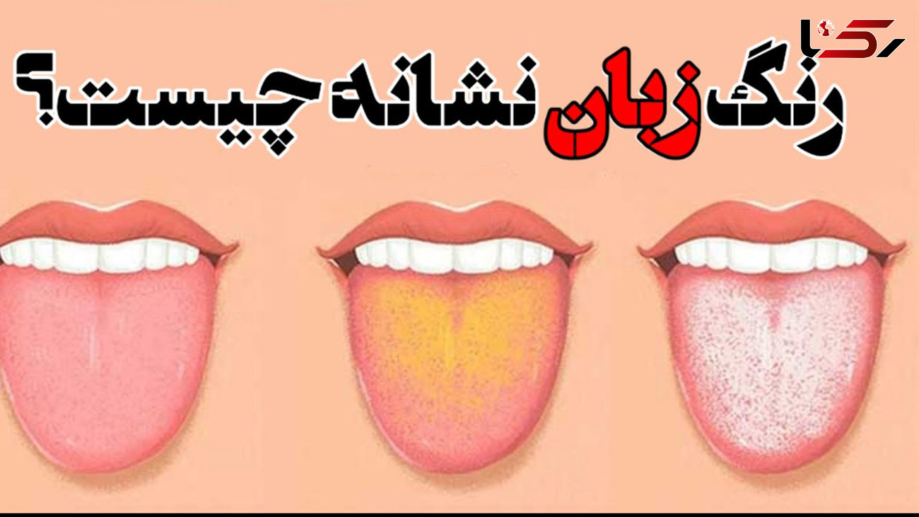 نشانه های بیماری از روی رنگ زبان 