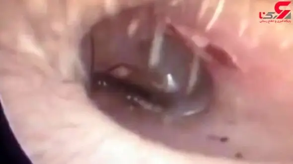 خارج کردن سوسک از گوش مرد جوان + فیلم