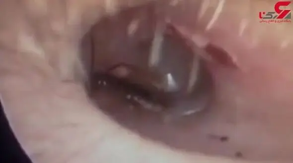 خارج کردن سوسک از گوش مرد جوان + فیلم