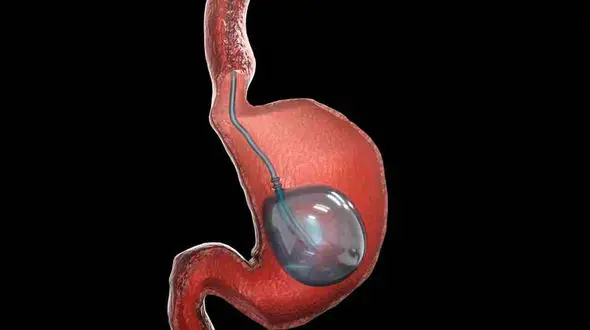 بالون معده چگونه کار می کند؟ + فیلم