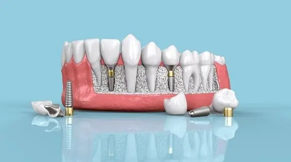 ایمپلنت و لمینت چه تفاوت‌هایی دارند؟
