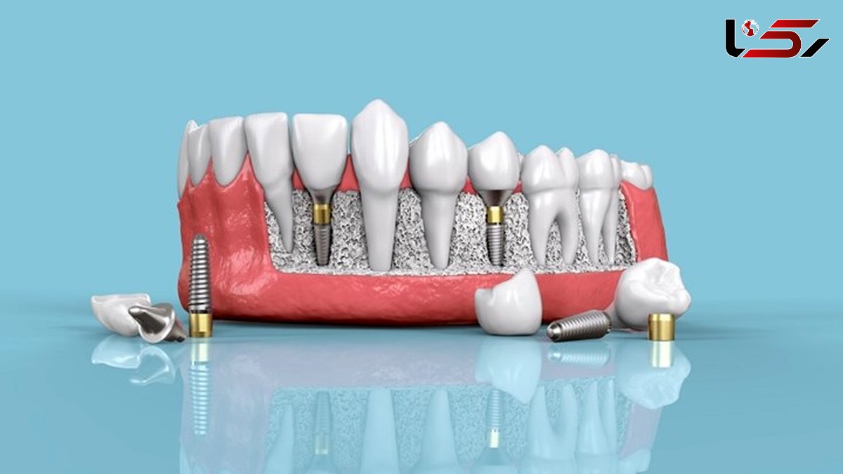 ایمپلنت و لمینت چه تفاوت‌هایی دارند؟