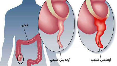 آپاندیس چیست؟ / جدول علائم و نشانه‌ های آپاندیسیت