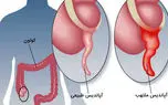 آپاندیس چیست؟ / جدول علائم و نشانه‌ های آپاندیسیت