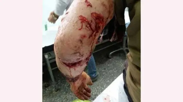 پلنگ  چوپان گیلانی را تیکه پاره کرد / چوپان به کما رفت + عکس 
