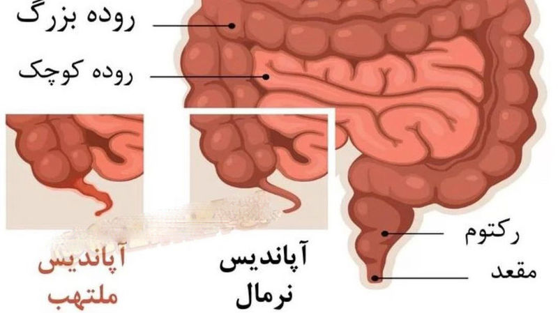 آپاندیس