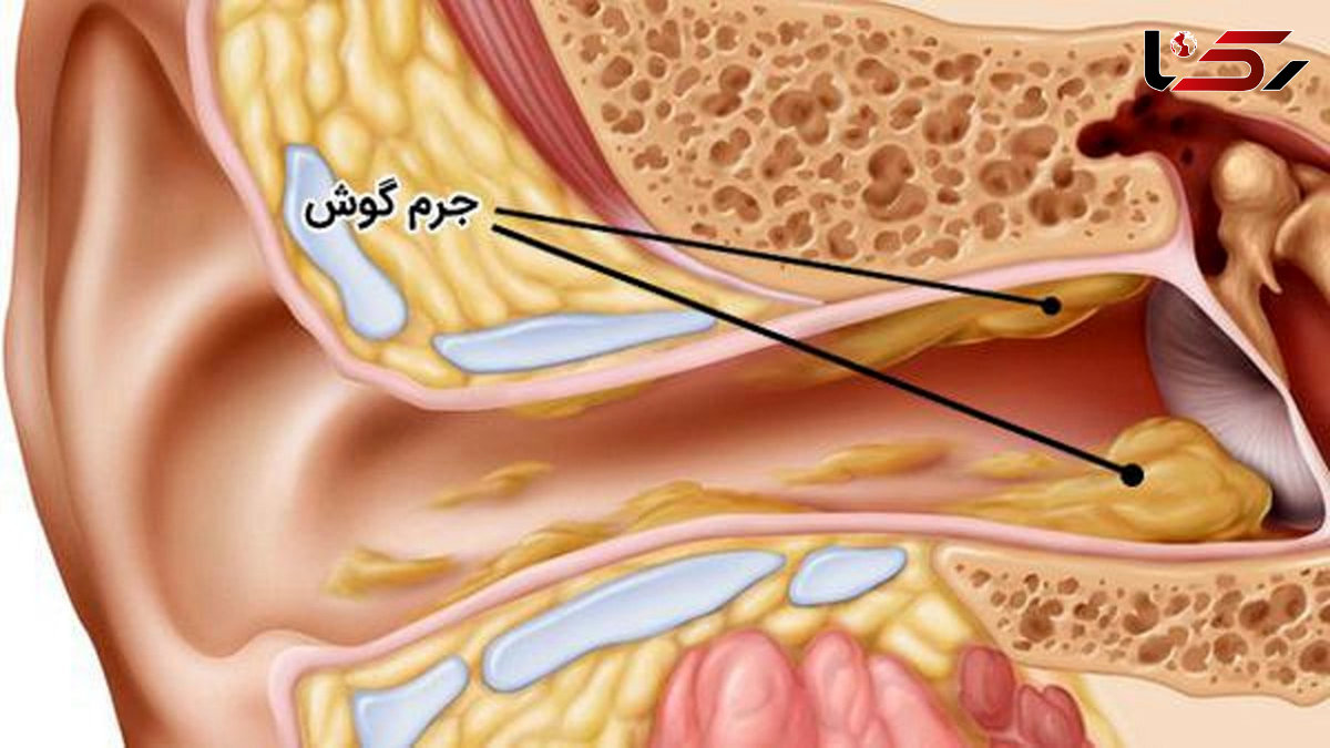 5 روش درمان خانگی جرم گوش