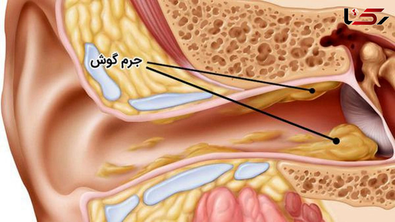 5 روش درمان خانگی جرم گوش