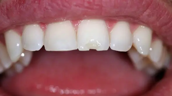 خوردن تخمه و اثر آن بر فاصله بین دندان‌ ها!