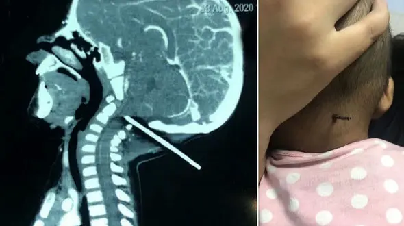 خارج کردن میله از سر یک کودک + فیلم وحشتناک