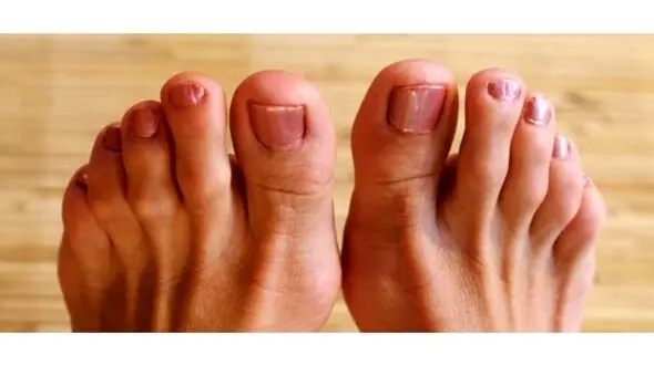 علت بیرون زدن استخوان شست پا چیست؟