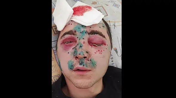 شکارچی کم بینا دوستش را به جای اردک شکارکرد ! + عکس / روسیه