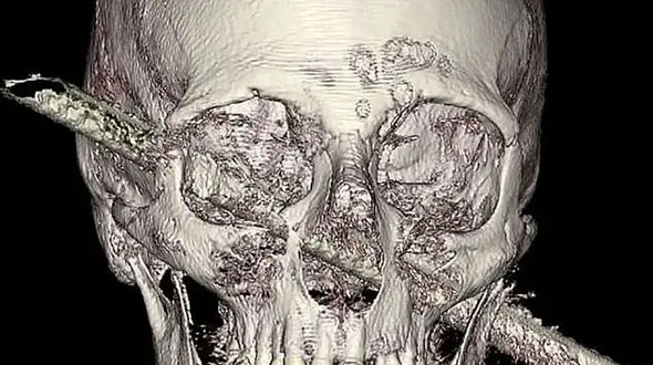 فرو رفتن میلگرد در صورت یک کارگر / این مرد یهودی 7 جان دارد + عکس