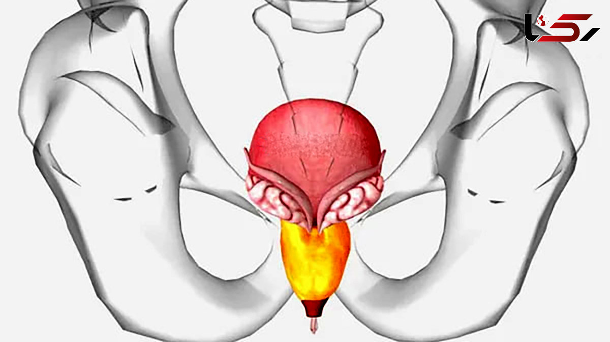 علت بزرگ شدن پروستات چیست؟ / نقش تغذیه در بزرگ شدن پروستات