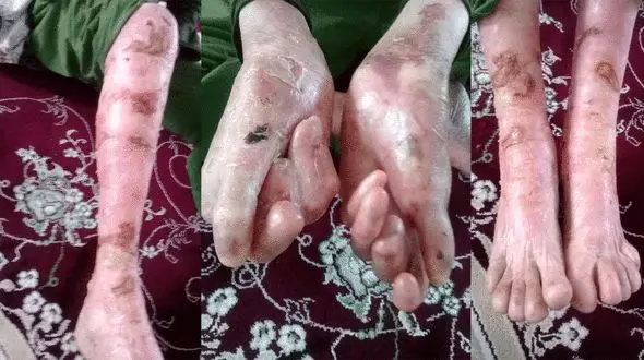 دختر بیمار ای بی را به بیمارستان راه ندادند / گفتند کرونا داری به خانه برو!  / در آمدم 150 هزار تومان بهزیستی است!