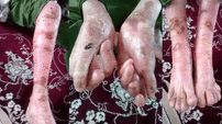 دختر بیمار ای بی را به بیمارستان راه ندادند / گفتند کرونا داری به خانه برو!  / در آمدم 150 هزار تومان بهزیستی است!