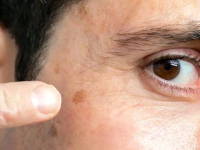چگونه نشانه‌ های اولیه سرطان پوست را بشناسیم؟