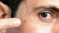 چگونه نشانه‌ های اولیه سرطان پوست را بشناسیم؟