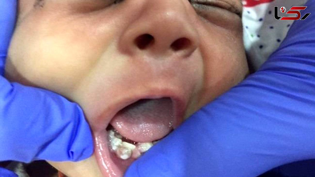 ۷ دندان نوزاد یکماهه هندی کشیده شد + عکس 