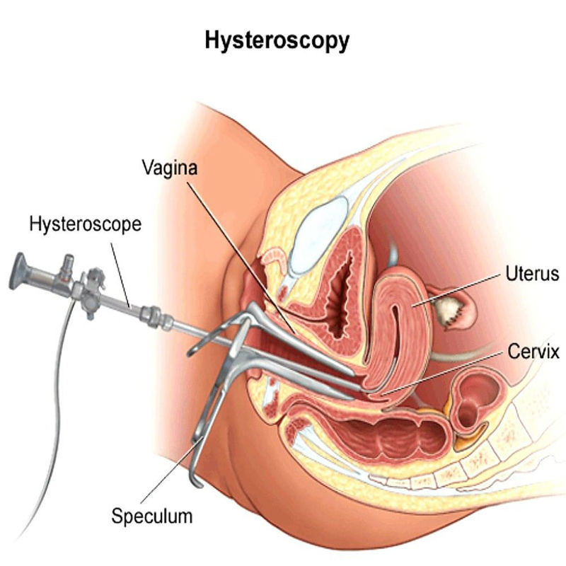 عملکرد هیستروسکوپی