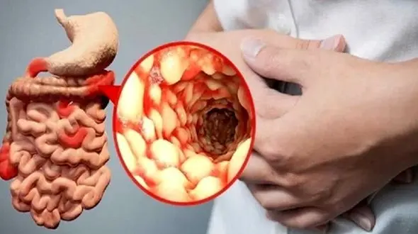 بیماری مرموز گوارشی در کمین ایرانیان