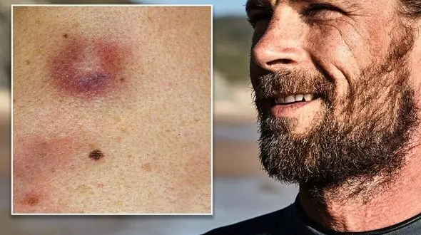 افزایش آمار سرطان پوست با گرمایش جهانی / اهالی شمال ایران بیشتر در معرض سرطان پوست هستند