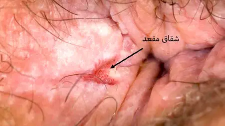 فیشر یا شقاق مقعدی چیست؟ 