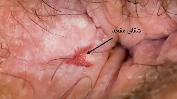 فیشر یا شقاق مقعدی چیست؟ 