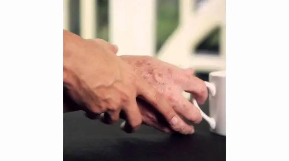 درمان ترمور یا لرزش با طب سوزنی 