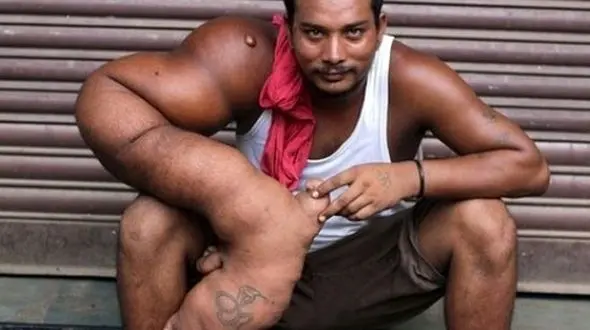 تصاویر دلخراش یک جوان هندی با دست 20 کیلویی عجیب و غریب!