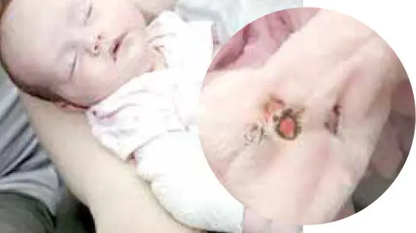 پرت کردن ته سیگار روشن نوزادی را سوزاند + عکس