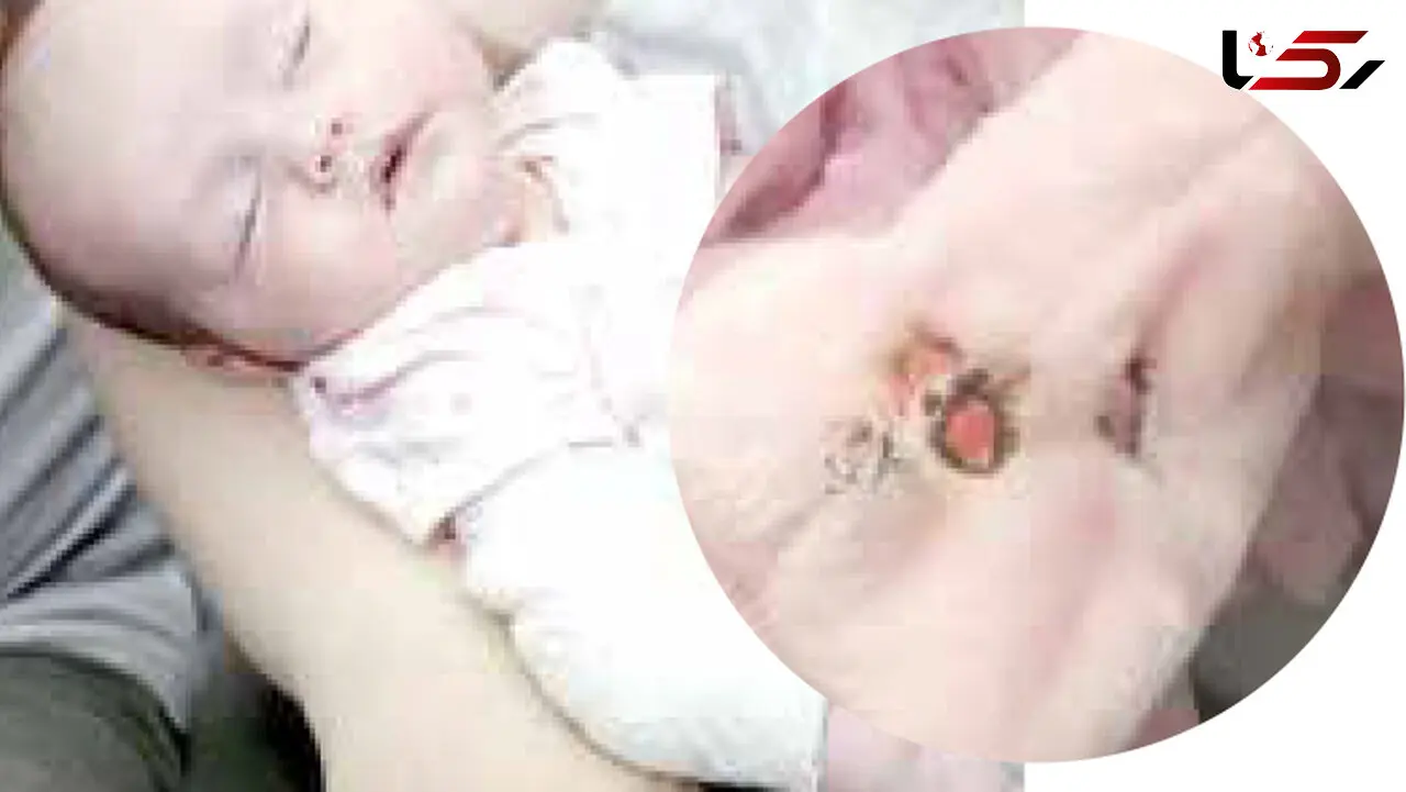 پرت کردن ته سیگار روشن نوزادی را سوزاند + عکس