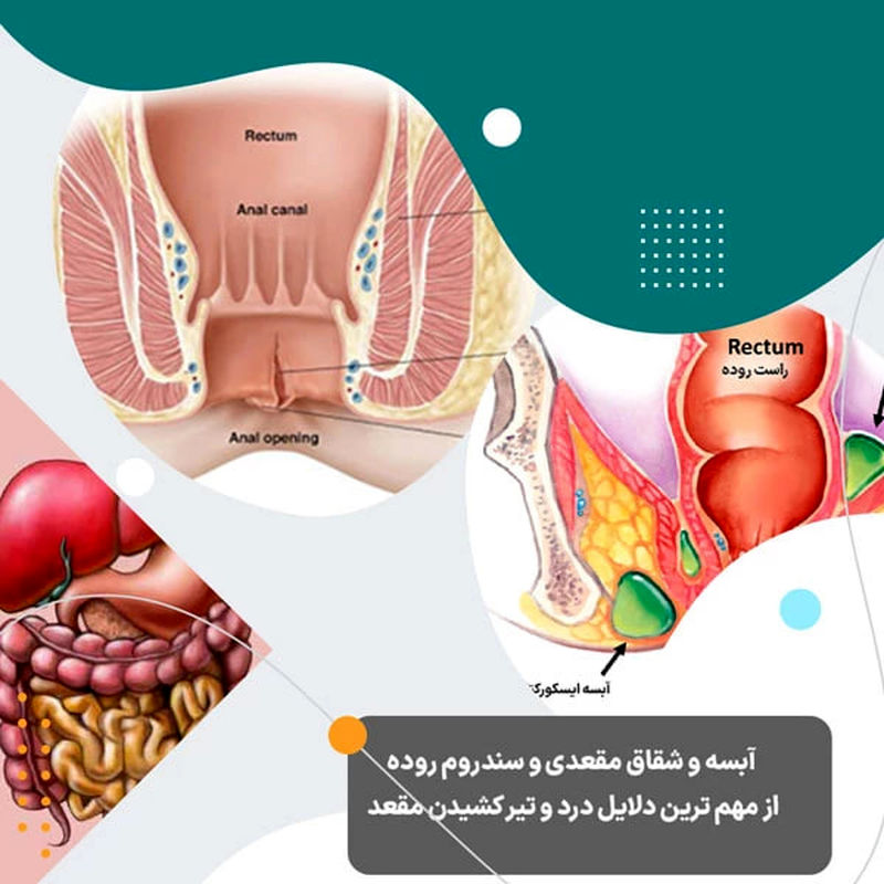 شقاق مقعدی